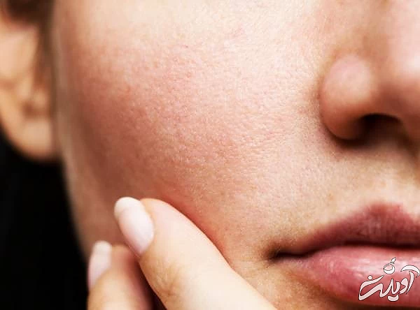 کاهش منافذ پوستی